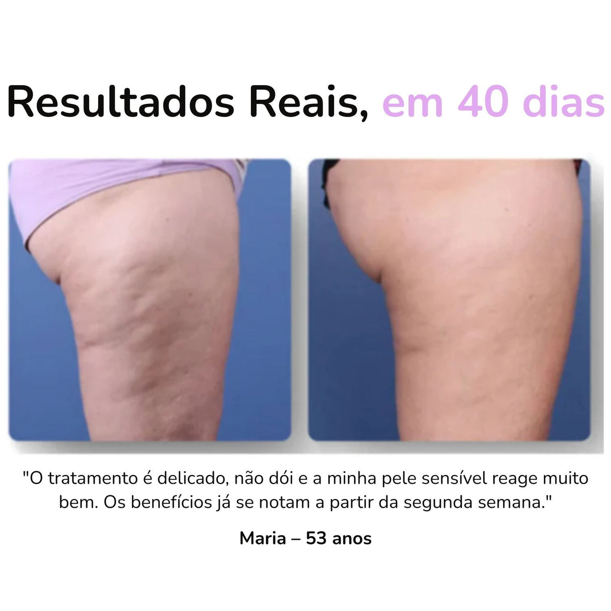 SheVitality™ Tratamento Profissional anticelulite